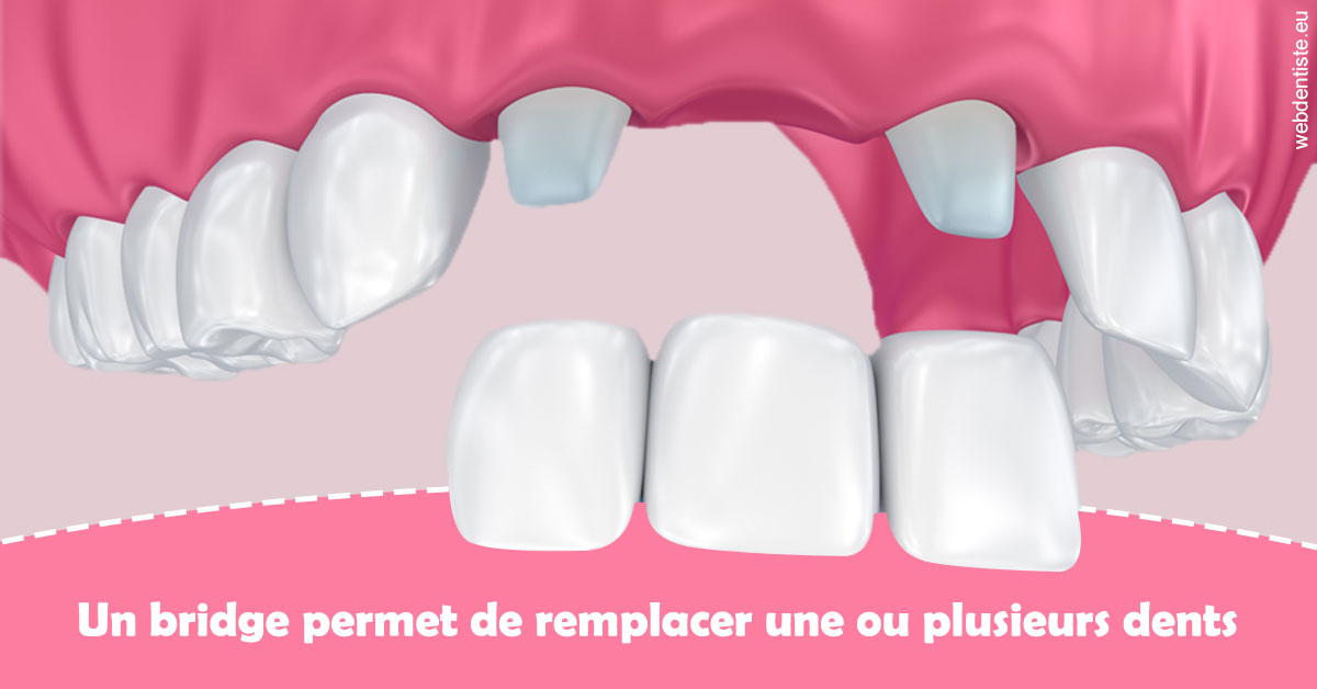https://selarl-docteur-valentine-sedennes.chirurgiens-dentistes.fr/Bridge remplacer dents 2